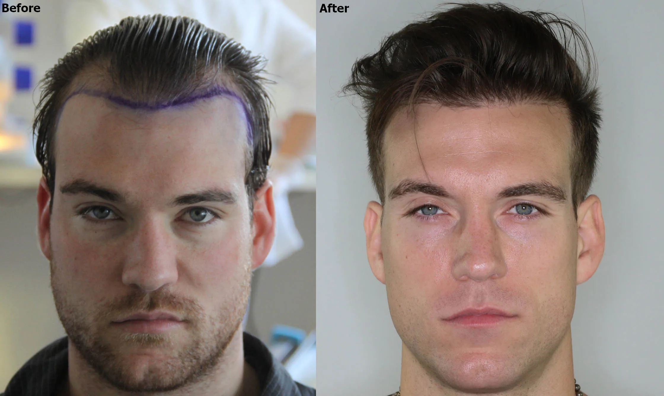 The Future of Hair Restoration: Hair Transplant UK Techniques