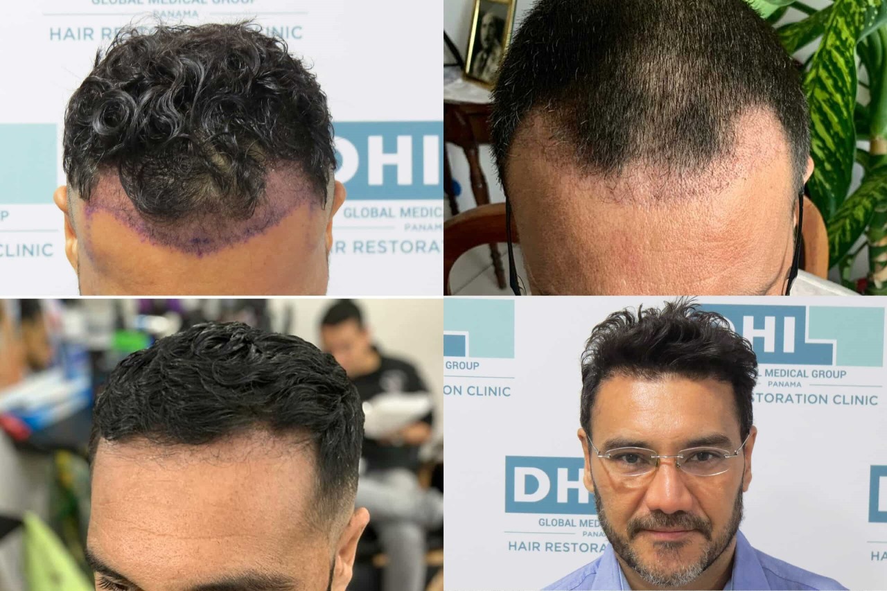 Hair Transplant London – Discreet, Professional, Life-Changing