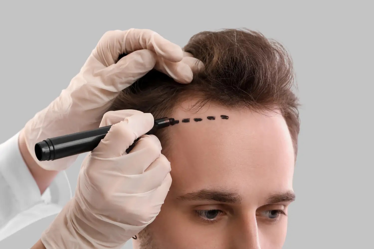 Hair Transplant Istanbul: Leading the Way in Cosmetic Excellence