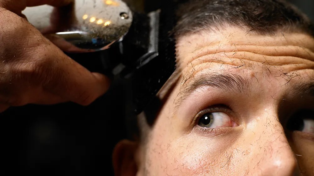 Sapphire Hair Clinic – Natural Hair Transplant Istanbul Results