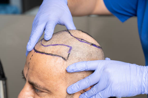 How Much Is Hair Transplant in Istanbul Clinics?